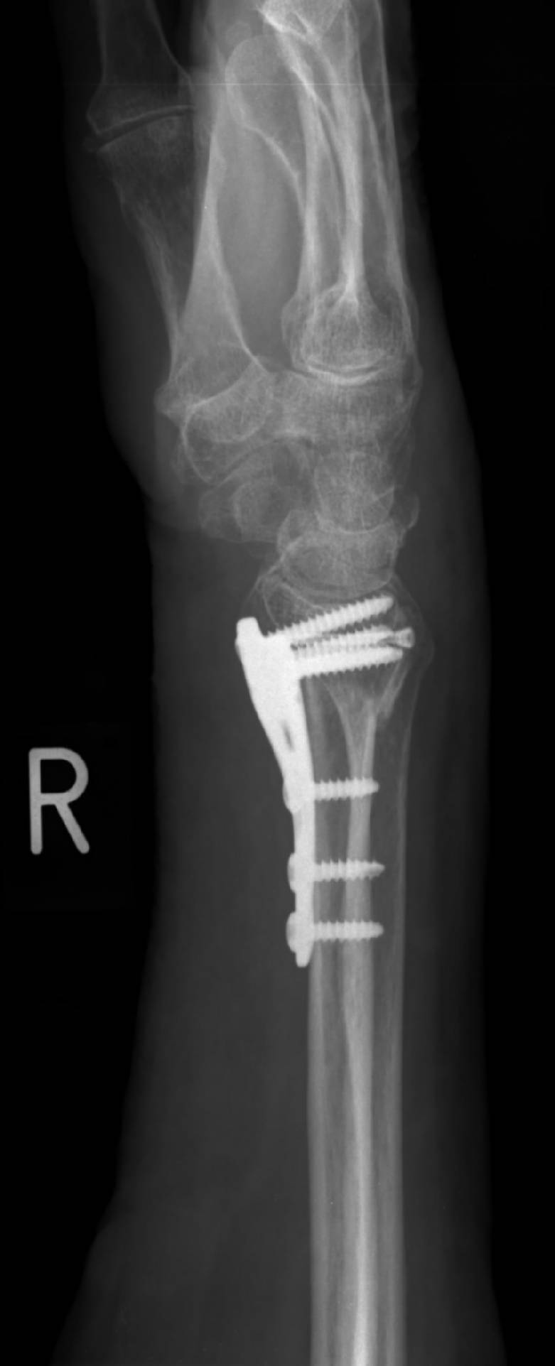 Heidemann - Hand- und Ellenbogenchirurgie in Hürth - Knochenbruchbehandlung